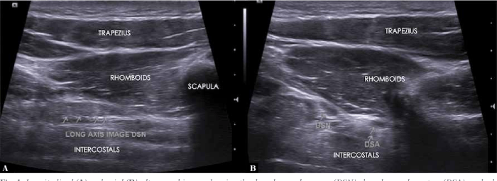 Scapular dorsal nerve entrapment