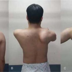 Scapular nerves dorsal axillary netter suprascapular nerve scapula anatomy joint radial supraspinatus นท