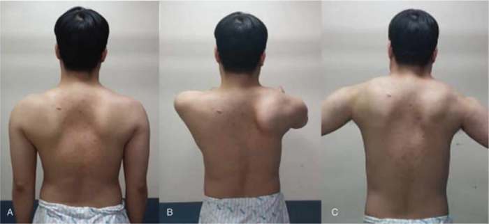 Scapular nerves dorsal axillary netter suprascapular nerve scapula anatomy joint radial supraspinatus นท